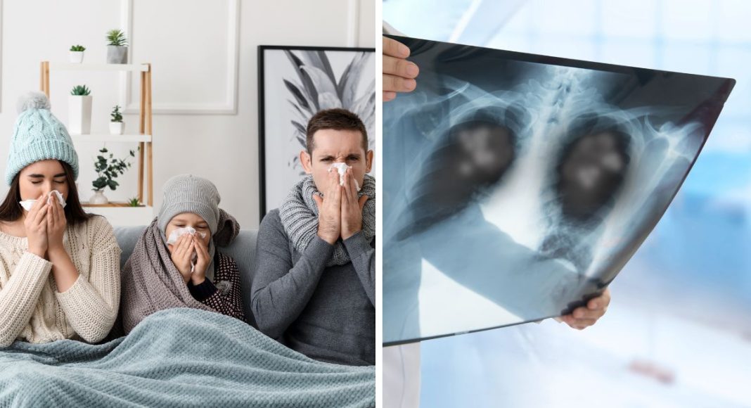 Komplikacije gripe